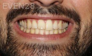 Todd-Emigh-Clear-Aligners-Before-4