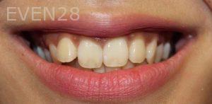 Todd-Emigh-Clear-Aligners-Before-5
