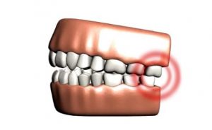 Wisdom-tooth-extraction