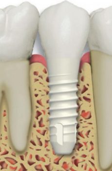 complete-full-ceramic-zirconia-holistic-Dental-implant