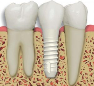 complete-full-ceramic-zirconia-holistic-Dental-implant