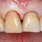 Alexander-Kalmanovich-Dental-Bonding-before-2