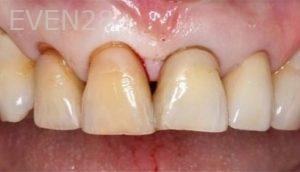 Alexander-Kalmanovich-Dental-Bonding-before-2