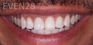 Alexander-Kalmanovich-Dental-Crowns-after-1