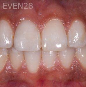 Alexander-Kalmanovich-Dental-Crowns-after-1b