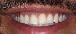 Alexander-Kalmanovich-Dental-Crowns-before-1