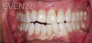 Alexander-Kalmanovich-Teeth-Whitening-after-1