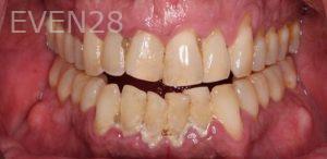 Alexander-Kalmanovich-Teeth-Whitening-before-1