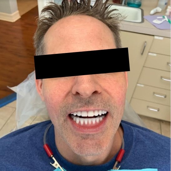 Ali-John-Jazayeri-Dental-Implant-All-on-Four-After-1a