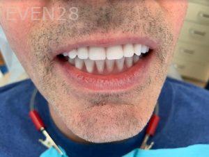 Ali-John-Jazayeri-Dental-Implant-All-on-Four-After-1b