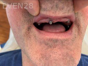 Ali-John-Jazayeri-Dental-Implant-All-on-Four-Before-1b