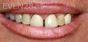 Ali-Mansouri-Dental-Crowns-before-1