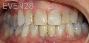 Ali-Mansouri-Dental-Crowns-before-2