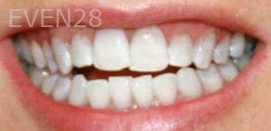 Ali-Mansouri-Teeth-Whitening-after-1