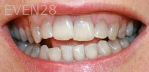 Ali-Mansouri-Teeth-Whitening-before-1