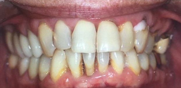 Amir-Larijani-Dental-Crowns-before-1