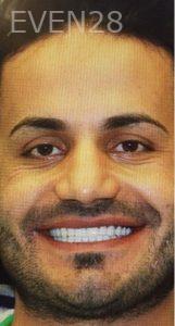 Amir-Larijani-Smile-Makeover-after-5