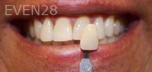 Amir-Larijani-Teeth-Whitening-before-1