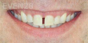 Andrew-Higgins-Dental-Bonding-before-1