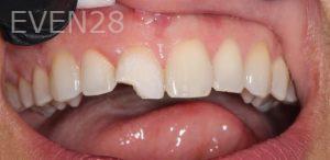 Andrew-Higgins-Dental-Bonding-before-2