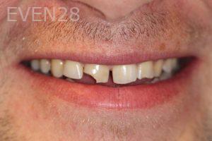 Andrew-Higgins-Dental-Bonding-before-3