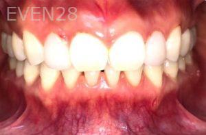 Ann-Nguyen-Invisalign-clear-aligners-after-1