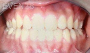 Ann-Nguyen-Invisalign-clear-aligners-after-10