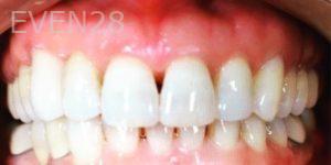 Ann-Nguyen-Invisalign-clear-aligners-after-11