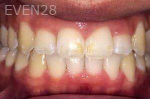 Ann-Nguyen-Invisalign-clear-aligners-after-3