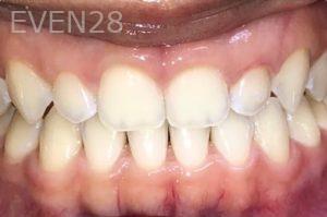 Ann-Nguyen-Invisalign-clear-aligners-after-4