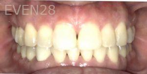 Ann-Nguyen-Invisalign-clear-aligners-after-5