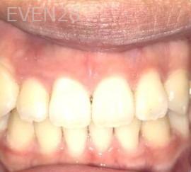 Ann-Nguyen-Invisalign-clear-aligners-after-7