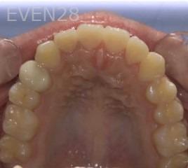 Ann-Nguyen-Invisalign-clear-aligners-after-7b