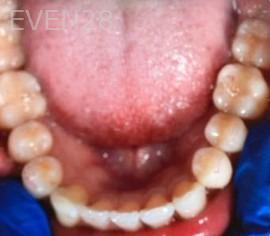 Ann-Nguyen-Invisalign-clear-aligners-after-9c