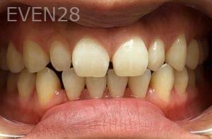 Ann-Nguyen-Invisalign-clear-aligners-before-1