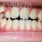 Ann-Nguyen-Invisalign-clear-aligners-before-10