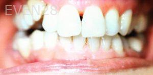 Ann-Nguyen-Invisalign-clear-aligners-before-11