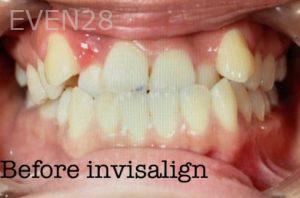 Ann-Nguyen-Invisalign-clear-aligners-before-2