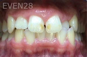 Ann-Nguyen-Invisalign-clear-aligners-before-3
