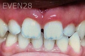 Ann-Nguyen-Invisalign-clear-aligners-before-4