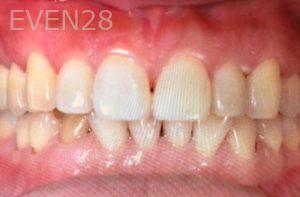 Ann-Nguyen-Invisalign-clear-aligners-before-5