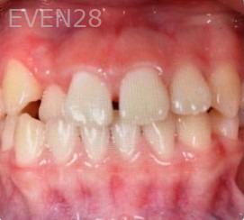 Ann-Nguyen-Invisalign-clear-aligners-before-7