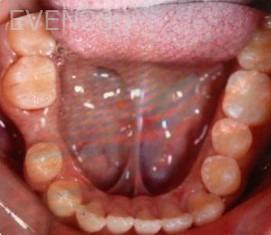 Ann-Nguyen-Invisalign-clear-aligners-before-7c