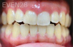 Ann-Nguyen-Invisalign-clear-aligners-before-8