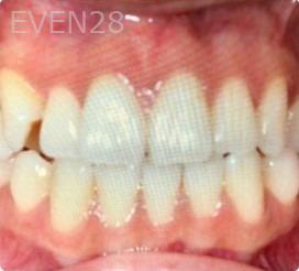 Ann-Nguyen-Invisalign-clear-aligners-before-9