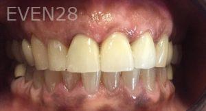 Anoosheh-Mazhari-Khorshidian-Dental-Crown-after-1