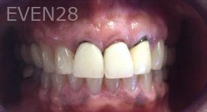 Anoosheh-Mazhari-Khorshidian-Dental-Crown-before-1