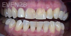 Brad-Lockhart-Dental-Crowns-before-1b