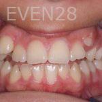Brad-Lockhart-Orthodontic-Braces-before-1