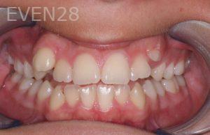 Brad-Lockhart-Orthodontic-Braces-before-1